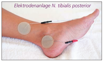 Stimulation des N tibialis posterior mit Klebeelektroden